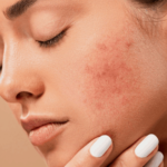 Skin Conditions Treated in Dermatology