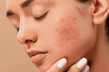 Skin Conditions Treated in Dermatology