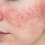Triggers and Symptoms of Rosacea