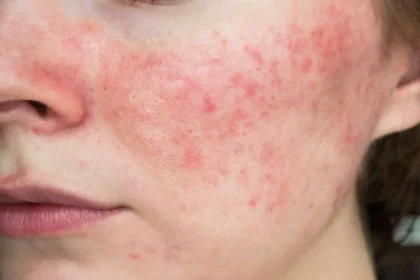Triggers and Symptoms of Rosacea