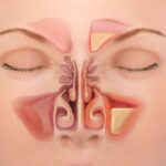 Chronic Sinusitis
