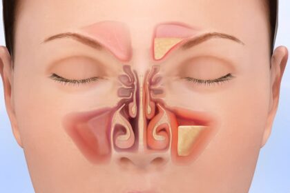 Chronic Sinusitis