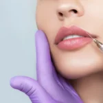 Dermal Fillers