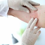 Dermatology in Treating Skin Infections
