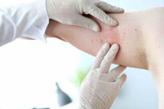 Dermatology in Treating Skin Infections