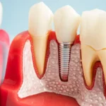 Endodontic Implants in Restoring Functionality