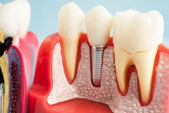 Endodontic Implants in Restoring Functionality