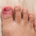Ingrown Toenail