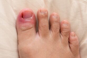Ingrown Toenail