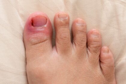 Ingrown Toenail