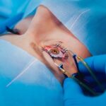 Enhancing Lasik Outcomes