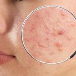Skin Conditions Treated by Dermatologists