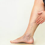 varicose veins