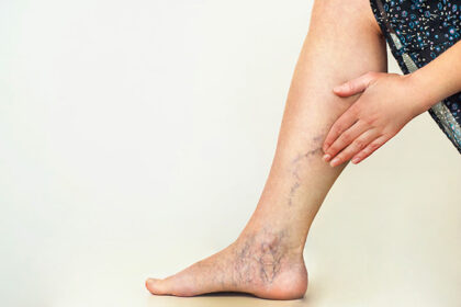varicose veins