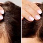 hair loss Treatments