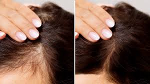 hair loss Treatments