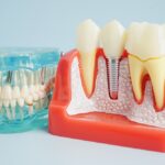 Benefits of Dental Implants