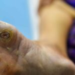 Diabetic Wound Complications