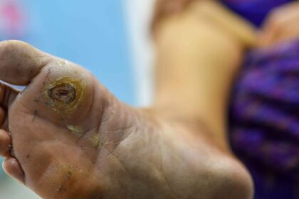 Diabetic Wound Complications