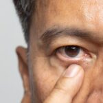 Different Types of Cataracts