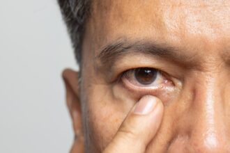 Different Types of Cataracts