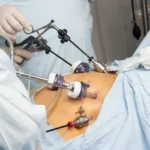 Gallbladder Removal Surgery