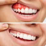 Managing Gum Disease