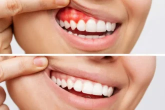 Managing Gum Disease