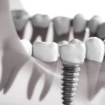 Immediate vs. Delayed Dental Implants: Pros and Cons