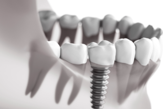 Immediate vs. Delayed Dental Implants: Pros and Cons