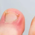 Ingrown Toenail Symptoms and Treatments