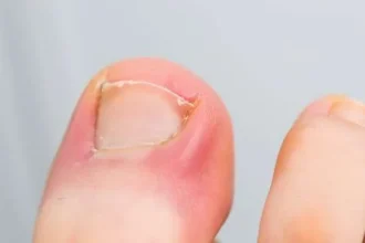 Ingrown Toenail Symptoms and Treatments